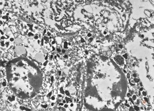 F,21y. | bone marrow - mastocytosis